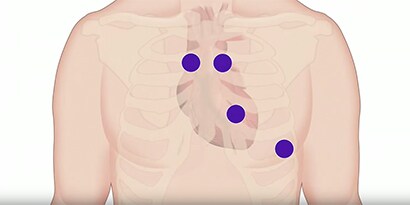 Illustration af brystet med auscultation steder angivet med blå prikker.
