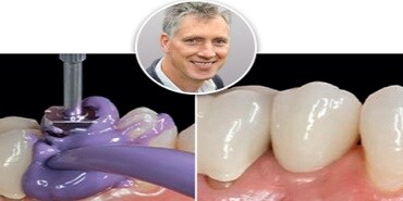Case: Implantatbaseret helkeramisk restaurering
