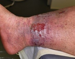 Lymphorrhea

