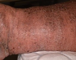 Fibrose
