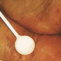 IAD inkontinensrelateret dermatitis