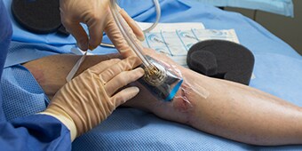 Patient knee with negtive pressure wound therapy
