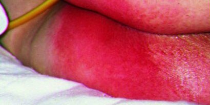 Inkontinensrelateret dermatitis
