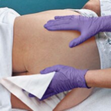 Inkontinensrelateret dermatitis