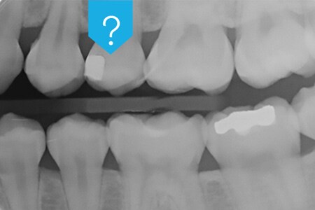 Røntgenbillede af tænder, der viser dental adhæsiv radiopacitet
