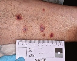 Follikulitis
