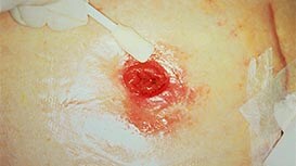 Peristomal hudskade                        
