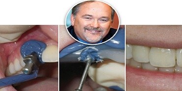 Case: Forudsigelige implantataftryk
