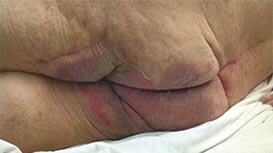 Inkontinensrelateret dermatitis (IAD)           
