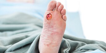 Diabetic foot ulcer
