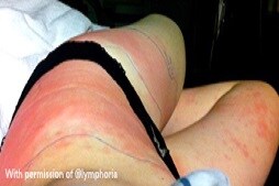 cellulitis
