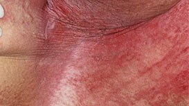 Intertriginøs dermatitis (ITD)
